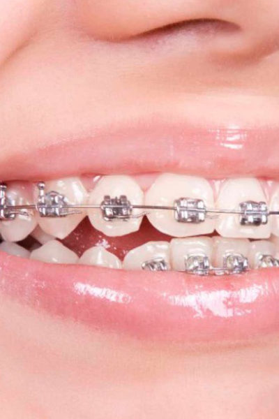snelweg overhandigen Gedachte Orthodontie | Smilez
